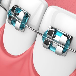 3d-render-of-custom-orthodontic-braces